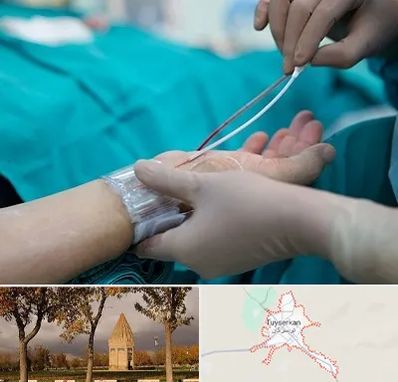 آنژیوگرافی در تویسرکان