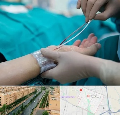 آنژیوگرافی در فاز سه اندیشه
