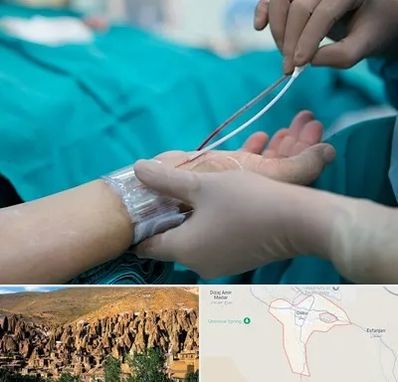 آنژیوگرافی در اسکو