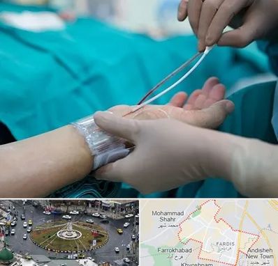 آنژیوگرافی در فردیس کرج 