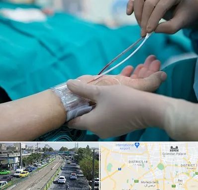 آنژیوگرافی در جنوب تهران 