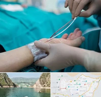 آنژیوگرافی در ایلام