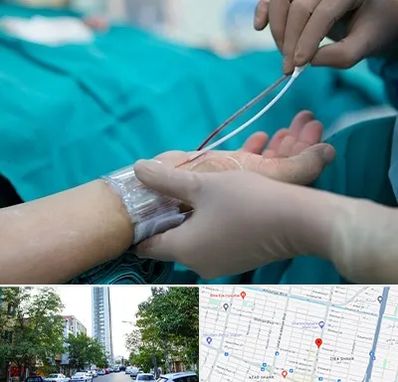 آنژیوگرافی در امامت مشهد