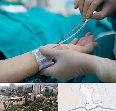 آنژیوگرافی در اوین