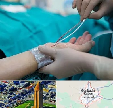 آنژیوگرافی در گنبد کاووس