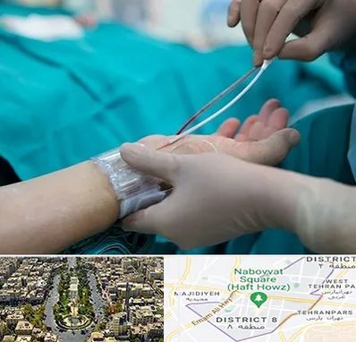 آنژیوگرافی در نارمک 