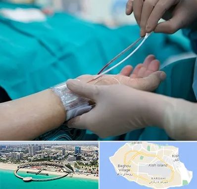 آنژیوگرافی در کیش