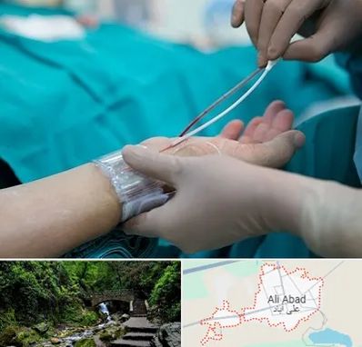 آنژیوگرافی در علی آباد کتول