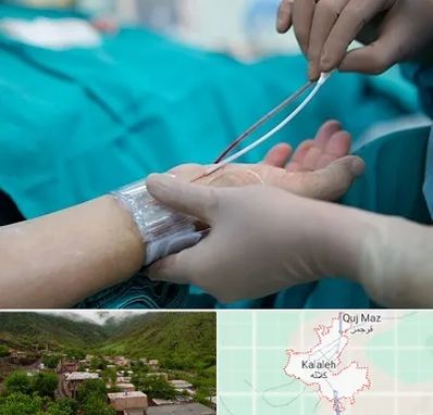 آنژیوگرافی در کلاله