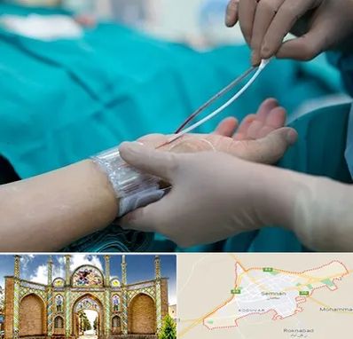 آنژیوگرافی در سمنان