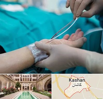 آنژیوگرافی در کاشان