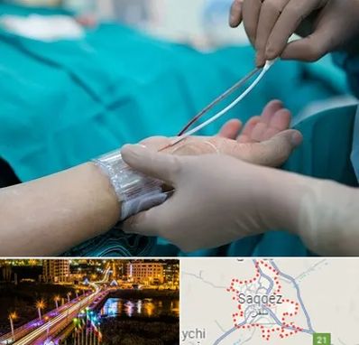 آنژیوگرافی در سقز