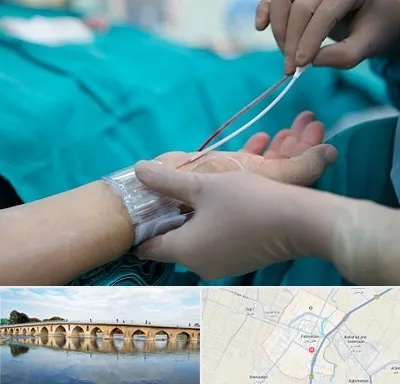 آنژیوگرافی در فلاورجان