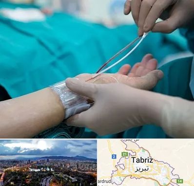 آنژیوگرافی در تبریز