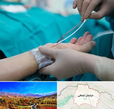 آنژیوگرافی در خراسان شمالی