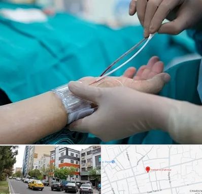 آنژیوگرافی در هفده شهریور تبریز