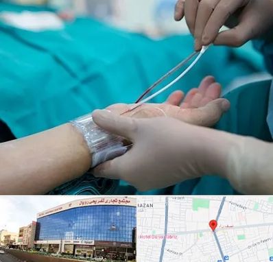 آنژیوگرافی در نصف راه تبریز