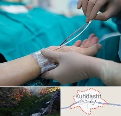 آنژیوگرافی در کوهدشت