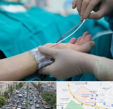 آنژیوگرافی در گلشهر کرج