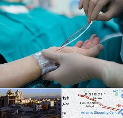 آنژیوگرافی در فرمانیه 