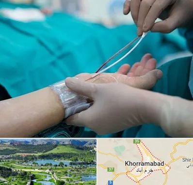 آنژیوگرافی در خرم آباد