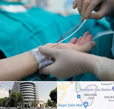 آنژیوگرافی در قلهک 