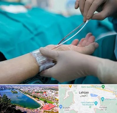 آنژیوگرافی در لاهیجان