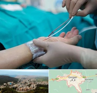 آنژیوگرافی در گرگان