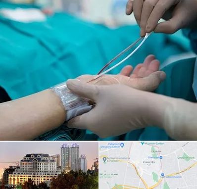 آنژیوگرافی در فرشته 