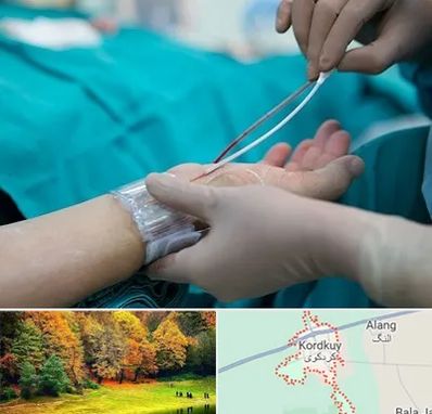 آنژیوگرافی در کردکوی