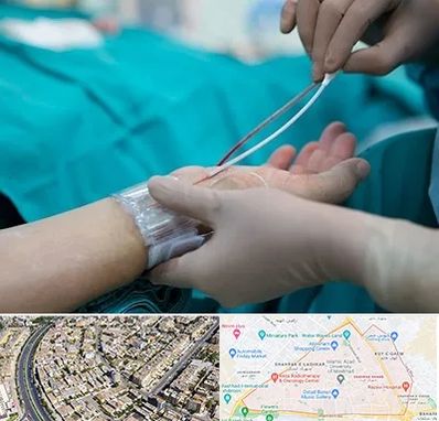 آنژیوگرافی در شهرک غرب مشهد