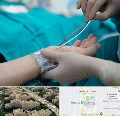 آنژیوگرافی در اکباتان 