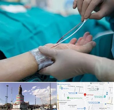 آنژیوگرافی در کارگر جنوبی