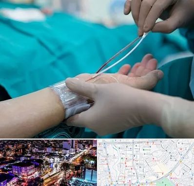 آنژیوگرافی در منظریه رشت