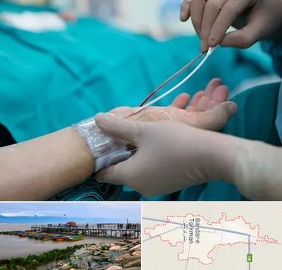 آنژیوگرافی در بندر ترکمن