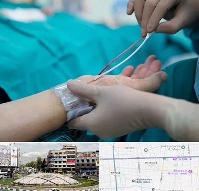 آنژیوگرافی در مرکز تهران