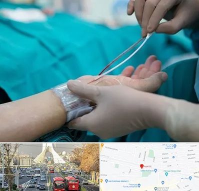آنژیوگرافی در خیابان آزادی