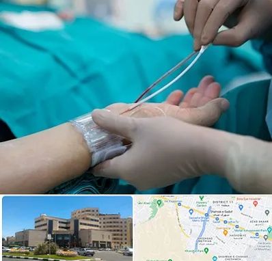 آنژیوگرافی در صیاد شیرازی مشهد