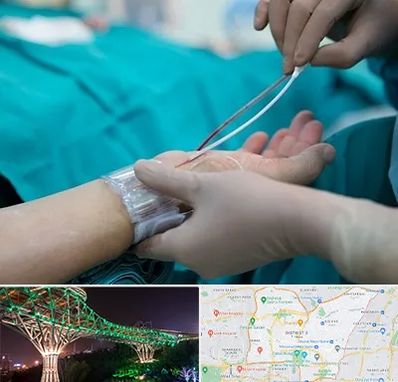 آنژیوگرافی در منطقه 3 تهران