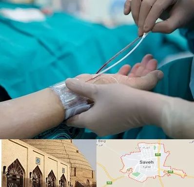 آنژیوگرافی در ساوه