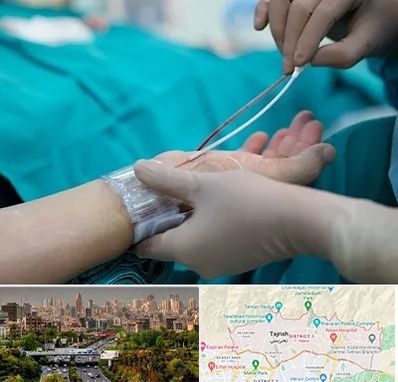 آنژیوگرافی در منطقه 1 تهران