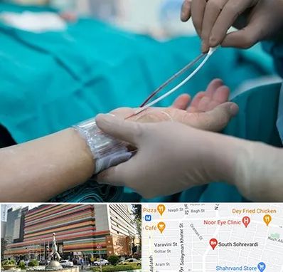 آنژیوگرافی در سهروردی 