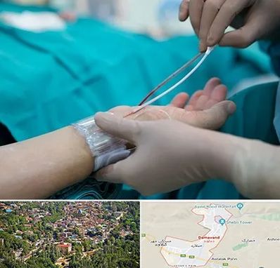 آنژیوگرافی در دماوند