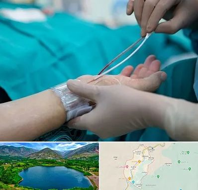 آنژیوگرافی در رودبار