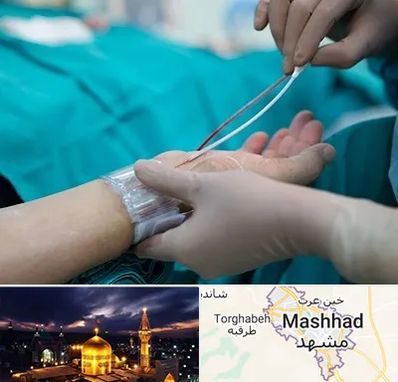 آنژیوگرافی در مشهد