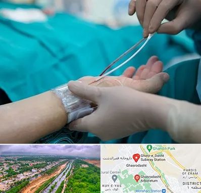 آنژیوگرافی در قصرالدشت شیراز