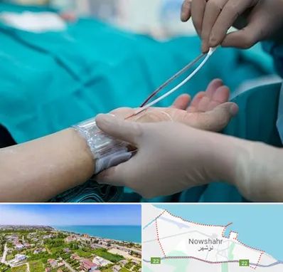آنژیوگرافی در نوشهر