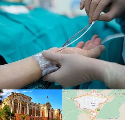 آنژیوگرافی در خوی