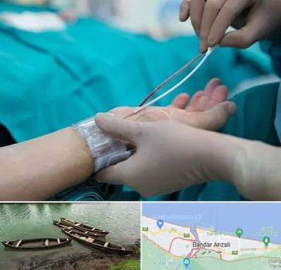 آنژیوگرافی در بندر انزلی