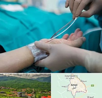 آنژیوگرافی در آمل